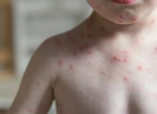 Confirma SSM primeros casos de sarampión en Michoacán